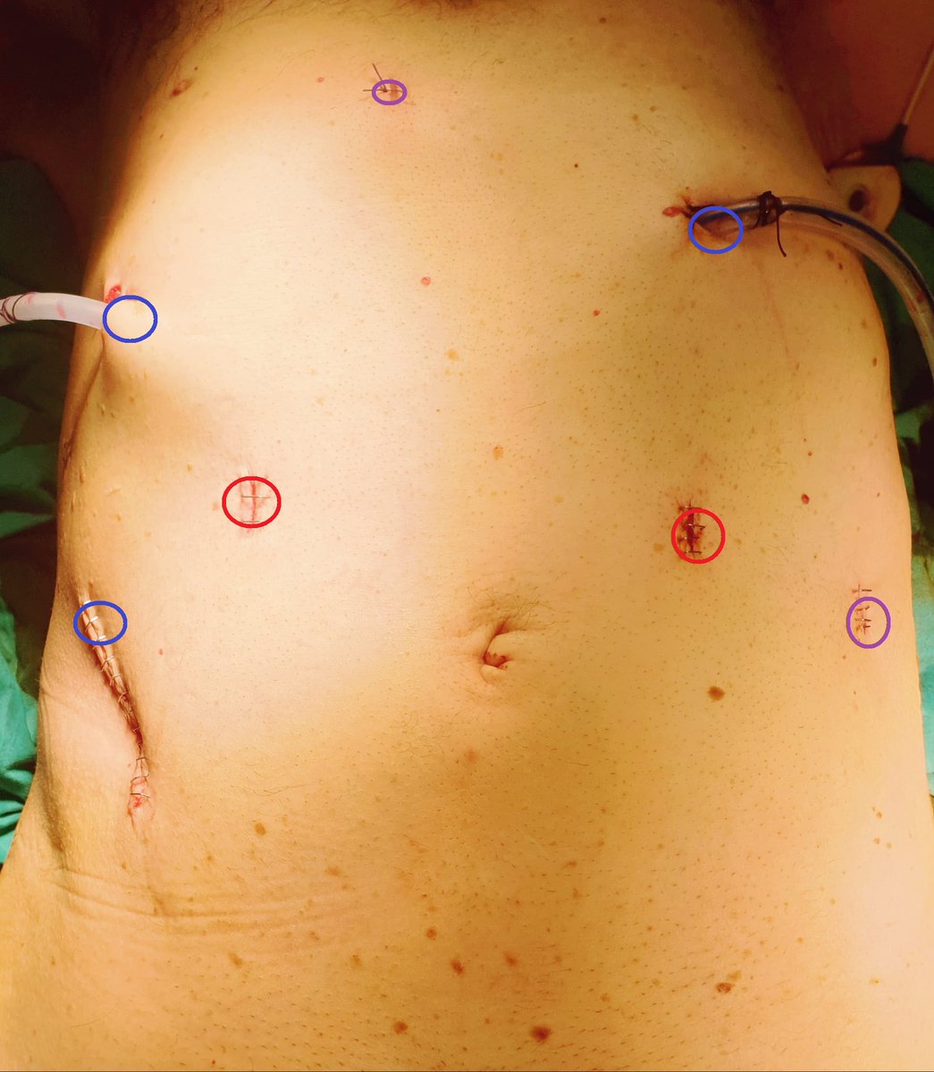 Bilateral kidney tumors; Left 10 cm invaded the left ureter, right 2 cm

#Laparoscopic left radical- right partial #nephrectomy in a single session 

To watch the full video without editing click below the link👇

youtu.be/qftPMlPty3I  

<a href="/KartalUroloji/">KARTAL ÜROLOJİ</a> <a href="/Orkunt8/">Orkunt özkaptan</a> <a href="/CubukAlkan/">Alkan Çubuk</a>