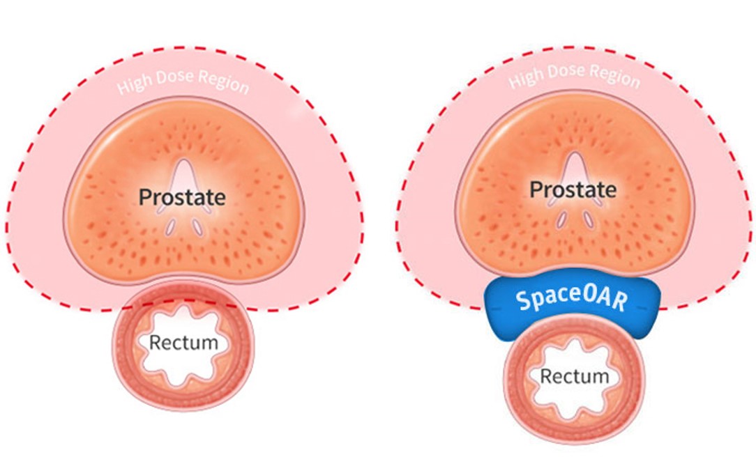 Just published in @ASTRO_org's PRO by @brennsstrahlung & @BrianBaumannMD: Feasibility of Same-Day Prostate Fiducial Markers, Perirectal Hydrogel Spacer Placement, & CT/MRI Simulation for #RadiationTherapy for...#prostatecancer pubmed.ncbi.nlm.nih.gov/34695615/