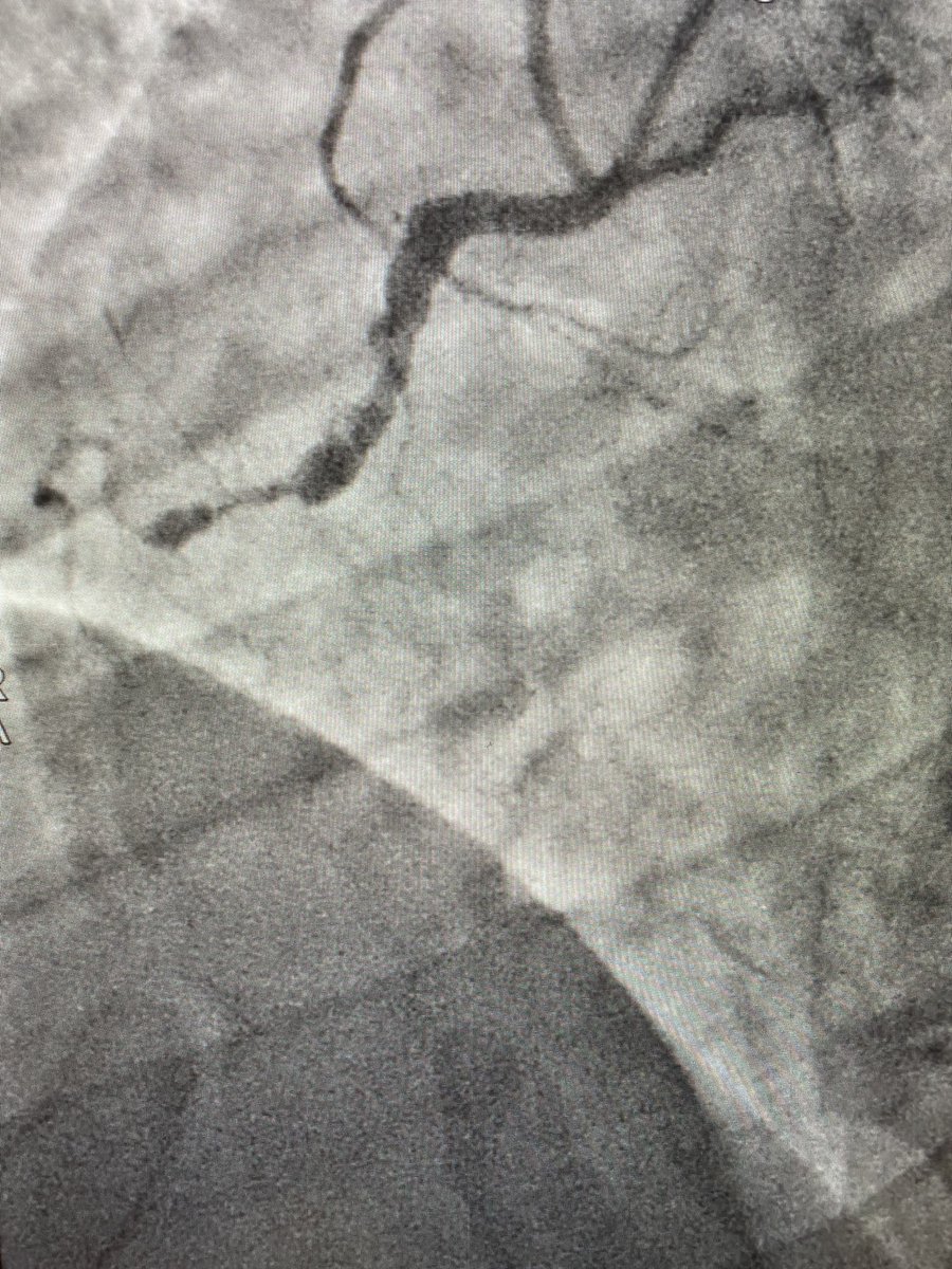 evandrofilhobr's tweet image. Antegrade CTO Intervention of RCA. “Simple approach”. 
Single access / Single CTO wire / Single MC.
Blunt/Calcium/Angulation/Antegrade filling from ipsilateral collaterals. #CTO101 #ICFIT