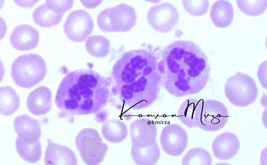 #HemeDaily #hemepath 

Trainees! What's the finding? And what is this phenomenon associated with?

#hematology #hematopathology <a href="/LoyolaHemePath/">Loyola Hematopathology</a> <a href="/loyolapathology/">Loyola Pathology & Laboratory Medicine</a> @MrMork87 <a href="/maryamraoufMD/">Maryam F Raouf</a> @SamreenfatimaMD