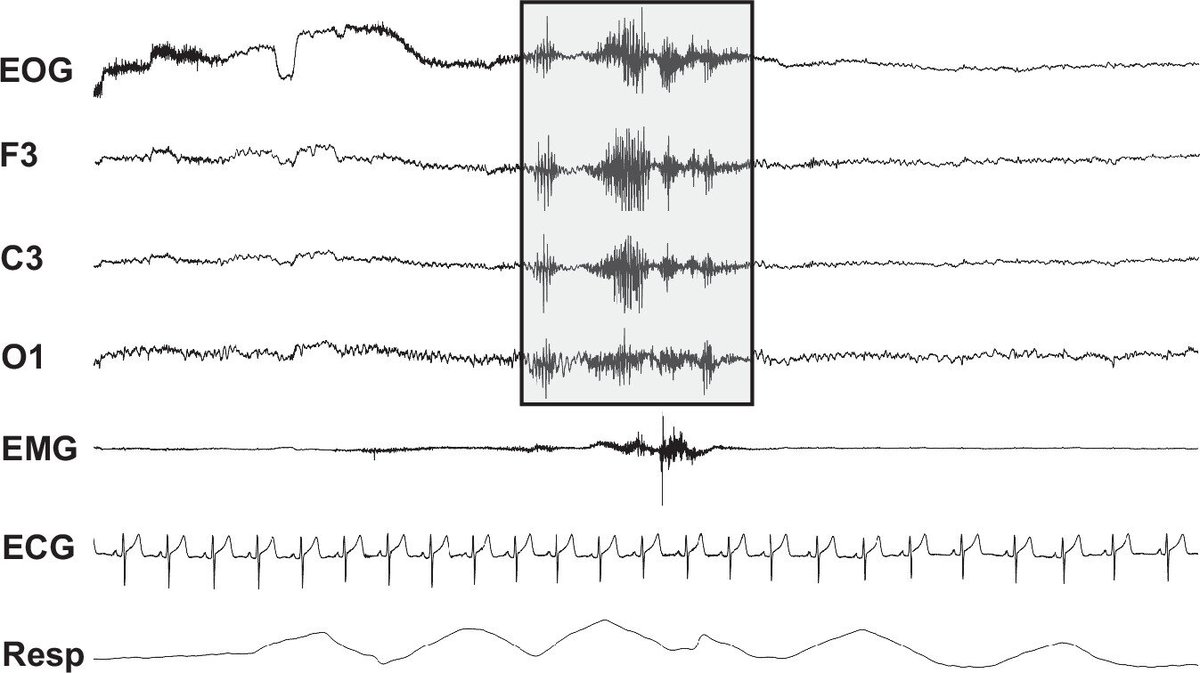 AASMorg's tweet photo. Habitual short sleepers have abnormal heart rate patterns during the night, a new study finds. Short sleepers had a more elevated heart rate after nocturnal arousals and their hearts took longer to return to normal compared to those who slept 7+ hours. https://t.co/htgwymztCP https://t.co/tq2kkcACPq