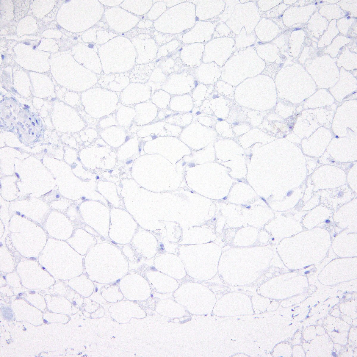 BWHPath's tweet photo. #BWHPathCotW
Pt with large tender left flank mass. H&amp;E shows a brown-fat-filled neoplasm with abundant vasculature and a classic mix of eosinophilic granular cells, multivacuolated cells, and mature adipocytes. IHC for MDM2 and CDK4 are negative. What's your diagnosis? #STPath
1/ https://t.co/X8I8yLBzEB