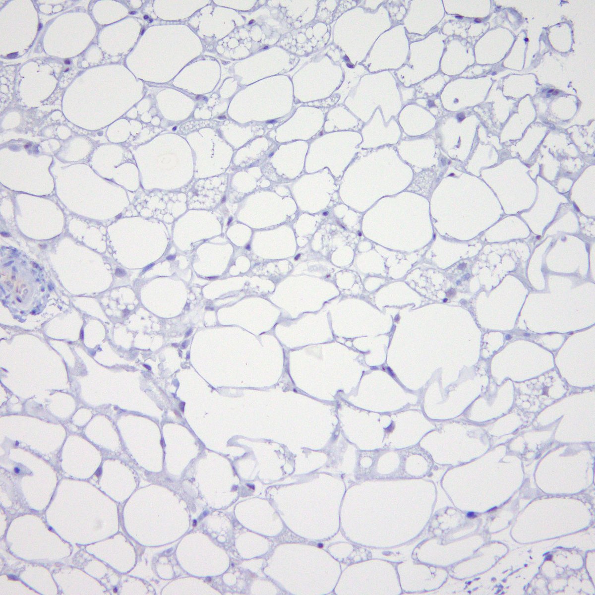 BWHPath's tweet photo. #BWHPathCotW
Pt with large tender left flank mass. H&amp;E shows a brown-fat-filled neoplasm with abundant vasculature and a classic mix of eosinophilic granular cells, multivacuolated cells, and mature adipocytes. IHC for MDM2 and CDK4 are negative. What's your diagnosis? #STPath
1/ https://t.co/X8I8yLBzEB