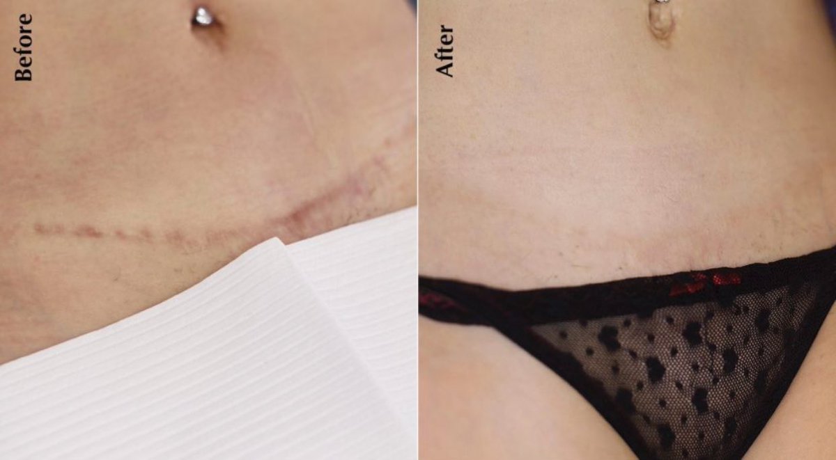 We have a new service at <a href="/serenityskins_/">Serenity Aesthetics</a> ✨ .

Scar camouflage tattoos. Good for those with:
-tummy tucks
-stretch marks 
-vitiligo 
-melasma