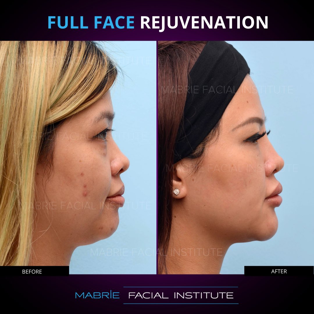 DavidMabrieMD's tweet photo. 💜 Full Face Rejuvenation 💜

This patient knew exactly what she 
desired, to look younger and more beautiful! We were able to achieve her goals.

📱- 415-445-9513⁠⠀
📧 - IG@drmabrie.com⁠⁠
🌎- https://t.co/CWpoyJeXaF⁠⠀

#chin #jawline #aginggracefully #nonsurgical https://t.co/1cBP5bhRQl
