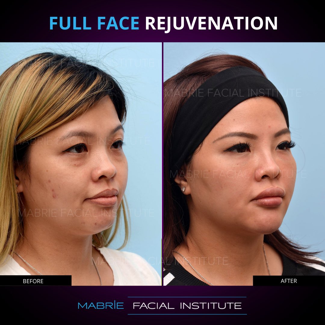 DavidMabrieMD's tweet photo. 💜 Full Face Rejuvenation 💜

This patient knew exactly what she 
desired, to look younger and more beautiful! We were able to achieve her goals.

📱- 415-445-9513⁠⠀
📧 - IG@drmabrie.com⁠⁠
🌎- https://t.co/CWpoyJeXaF⁠⠀

#chin #jawline #aginggracefully #nonsurgical https://t.co/1cBP5bhRQl