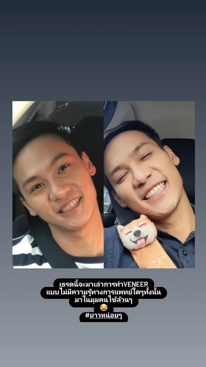 BankSongsak's tweet photo. เธรดนี้จะมาเล่าการทำ "veneer20ซี่!"
อันแสนยาวนานของเรา เสร็จสักที
ฝันอยากยิ้มจักรวาลมาตั้งแต่เด็ก 
ต้องได้ทำ!!!

*** มีรูปที่น่ากลัวปนอยู่หลายรูป *** https://t.co/PybSg2ewrN