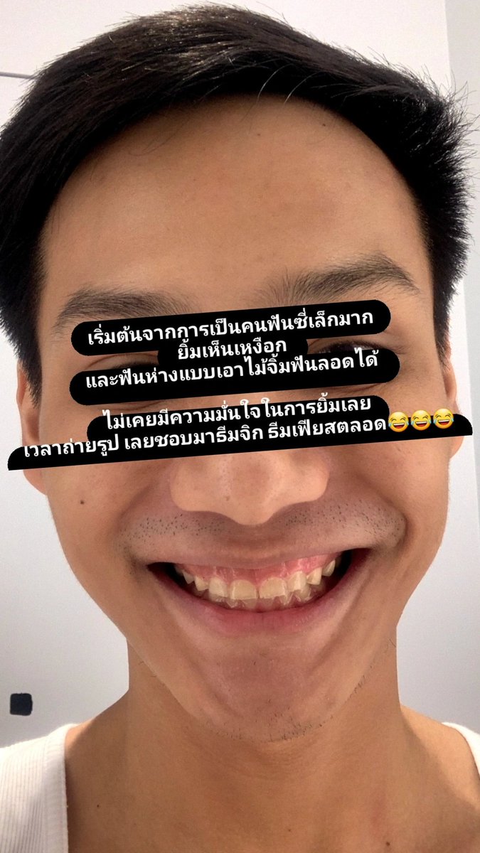 BankSongsak's tweet photo. เธรดนี้จะมาเล่าการทำ "veneer20ซี่!"
อันแสนยาวนานของเรา เสร็จสักที
ฝันอยากยิ้มจักรวาลมาตั้งแต่เด็ก 
ต้องได้ทำ!!!

*** มีรูปที่น่ากลัวปนอยู่หลายรูป *** https://t.co/PybSg2ewrN