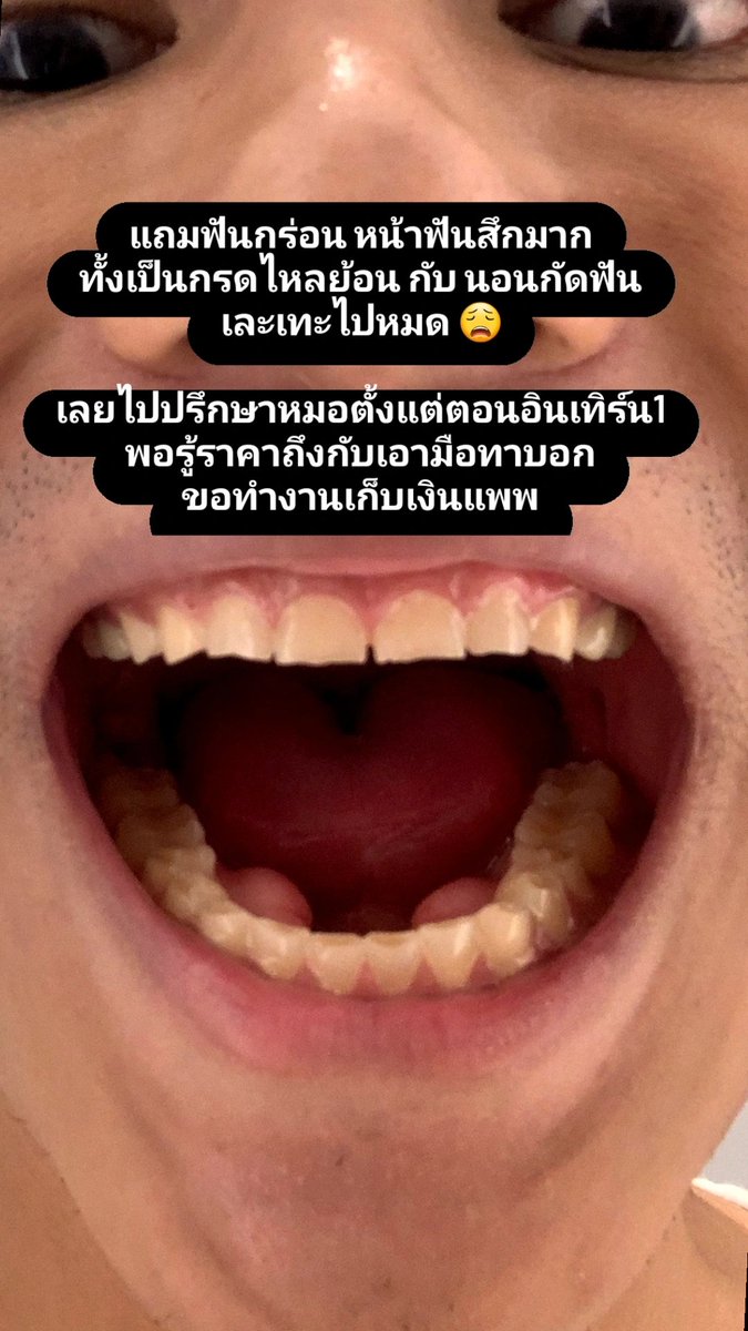 BankSongsak's tweet photo. เธรดนี้จะมาเล่าการทำ "veneer20ซี่!"
อันแสนยาวนานของเรา เสร็จสักที
ฝันอยากยิ้มจักรวาลมาตั้งแต่เด็ก 
ต้องได้ทำ!!!

*** มีรูปที่น่ากลัวปนอยู่หลายรูป *** https://t.co/PybSg2ewrN