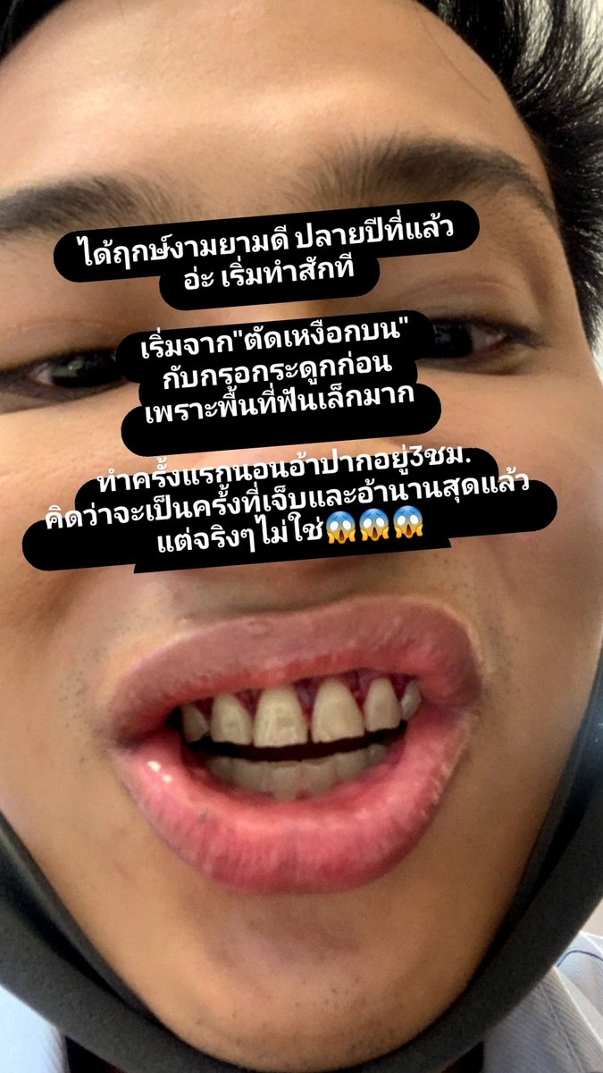 BankSongsak's tweet photo. เธรดนี้จะมาเล่าการทำ "veneer20ซี่!"
อันแสนยาวนานของเรา เสร็จสักที
ฝันอยากยิ้มจักรวาลมาตั้งแต่เด็ก 
ต้องได้ทำ!!!

*** มีรูปที่น่ากลัวปนอยู่หลายรูป *** https://t.co/PybSg2ewrN