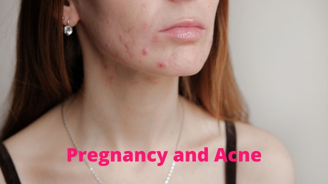 speciallymeco's tweet photo. November is National Healthy Skin Month. 

If you're wondering about your skin health while pregnant, check out this article on #acne during #pregnancy.
https://t.co/EtlWxwFYMF https://t.co/daxyIiA3K9