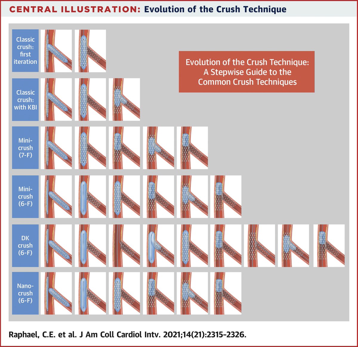 New #JACCINT issue is out! Classic crush, Mini-crush, DK-crush and Nano-crush: How did the crush techniques in bifurcation #PCI evolve w/ time? What are the outcomes of the different crush techniques? Read more in this state-of-the art review: bit.ly/3pZ8tXU #ACCIntl