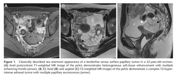 salvasapedraza's tweet photo. Ovarian Serous Surface Papillary Borderline Tumor: Sea Anemone Sign @RadioGraphics https://t.co/2ZeC3WJyra https://t.co/iZNweqQmG3