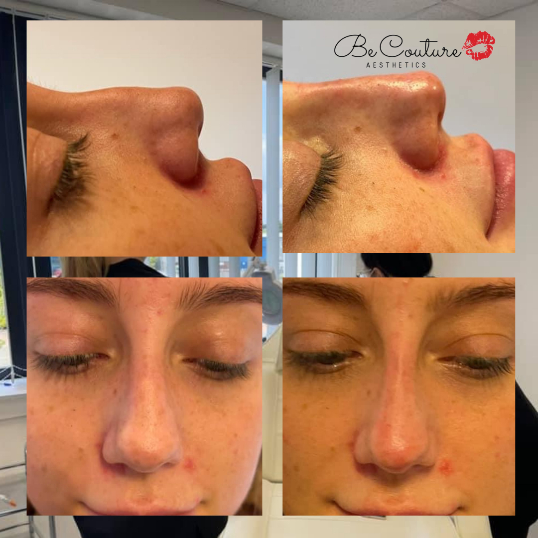 BeCoutureTrain's tweet photo. Take a look at how powerful a non-surgical rhinoplasty is 🤩

The results speak for themselves. 

Get yourself booked in now 📞❤️

.
.
.

.
#becoutureaesthetics #aesthetics #beauty #lipfiller #dermalfillers #fillers #aesthetic #ａｅｓｔｈｅｔｉｃ #clinic #beaut https://t.co/gRTbOolVRl