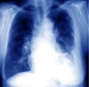 #LungCancerAwarenessMonth So if you have a persistent cough or short of breath have a check up  Earlier diagnosis saves lives and GPs ask the patient "Did you work with #Asbestos"  #mesothelioma