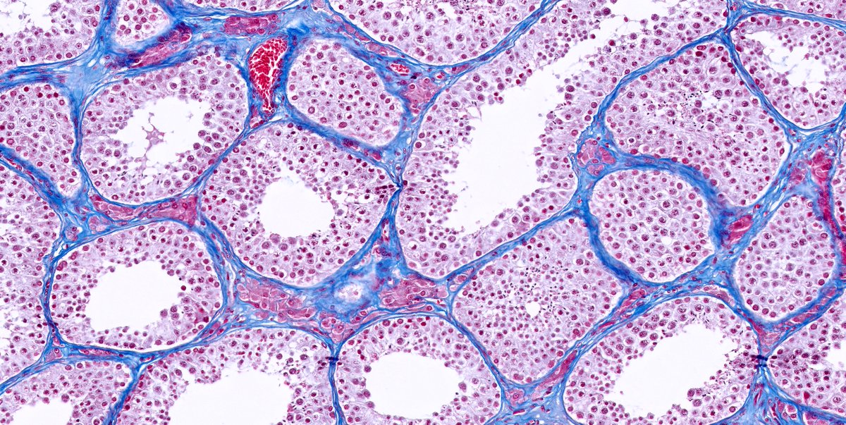 kis_lorand's tweet photo. I am deeply into this wonderful stain 😁 this time in the testis
#pathology #GUpath #funpath https://t.co/5VXdcuF35z