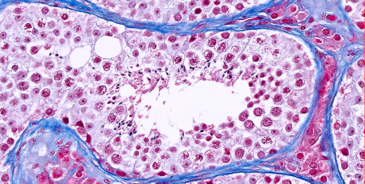 kis_lorand's tweet photo. I am deeply into this wonderful stain 😁 this time in the testis
#pathology #GUpath #funpath https://t.co/5VXdcuF35z