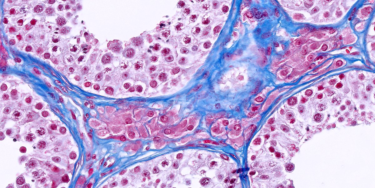 kis_lorand's tweet photo. I am deeply into this wonderful stain 😁 this time in the testis
#pathology #GUpath #funpath https://t.co/5VXdcuF35z