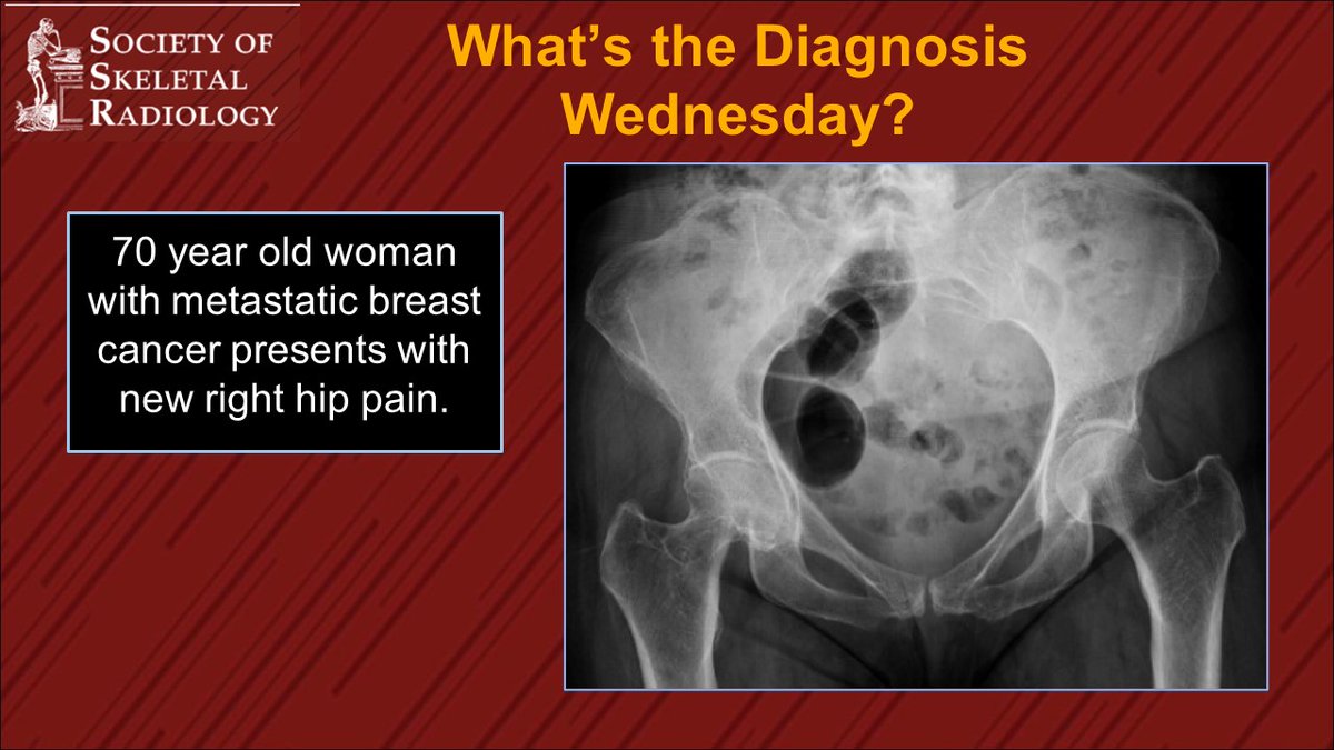ssr_rwg's tweet photo. It’s What’s the Dx Wednesday!! Let us know what you think, stay tuned for the answer later, and have a great Wednesday!     #radres #futureradres #MSKRad 
@theAPDR @VivekKaliaMD @CQuirkMSK https://t.co/jlWFIJZKbv