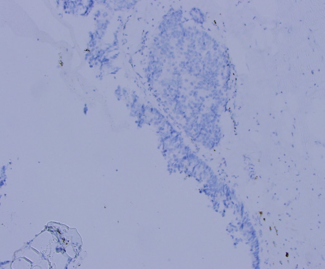 BIRAD 4B cystic mass in 50 years old. IHC is p63 #Breastpath