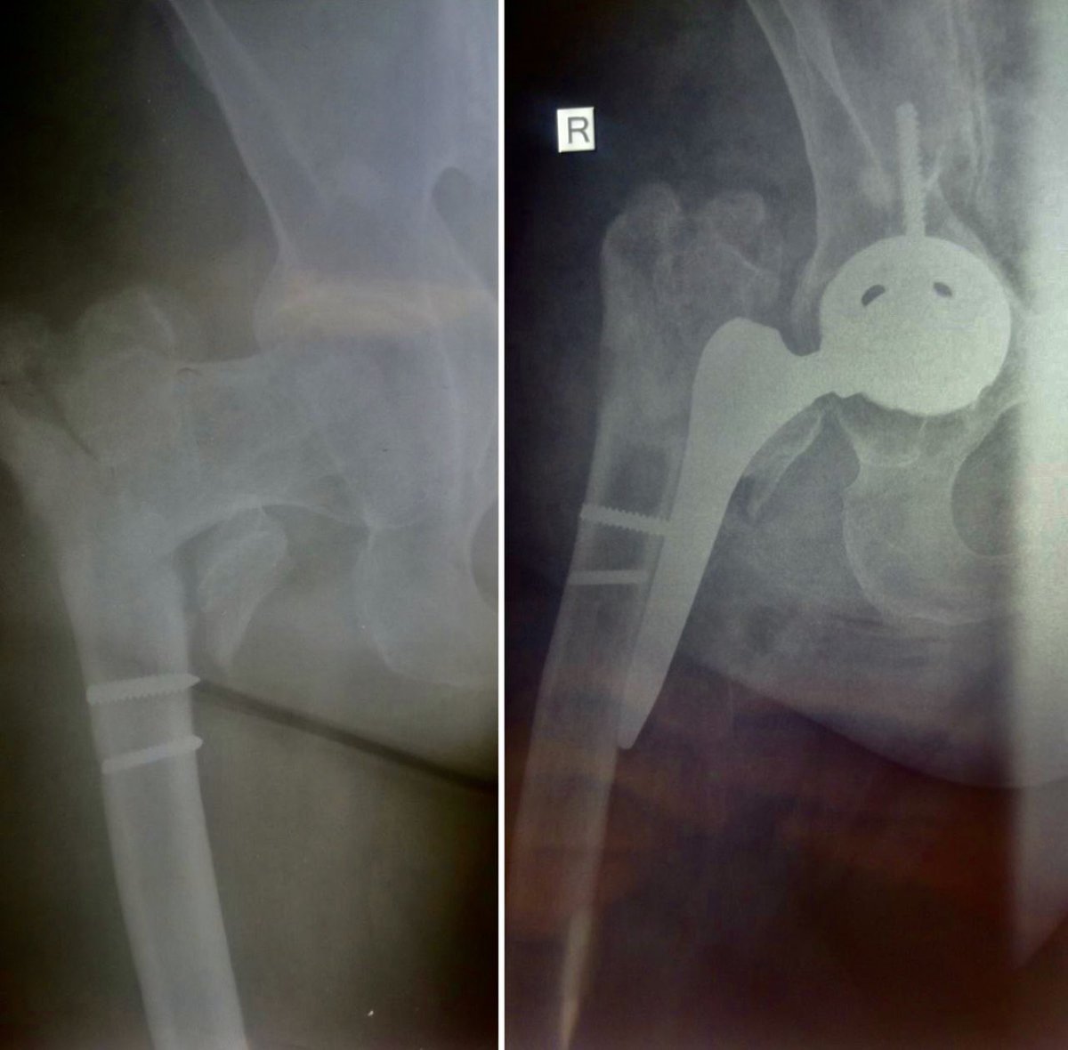 DrPasm's tweet photo. Another rare case that reaches the archives,
Case crazy, another outside !
what do you think?
#hipreplacement #hiparthroplastyrevision #hipreplacementsurgery #hipreplacementrecovery #hipreplacementsuccess #hiparthroplastysurgeries https://t.co/z4kpbSUvP1