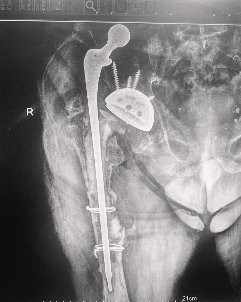 DrPasm's tweet photo. Another case report. What do you think 🤔?
#casereport🔎 #casepremium #hipreplacementsurgery #hipreplacementrevision https://t.co/963YRkMLOp