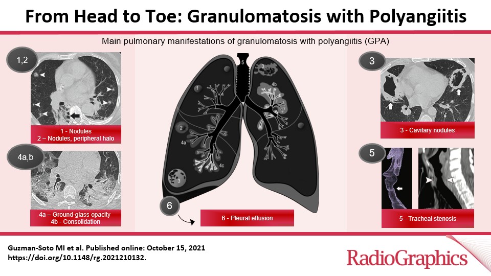 RadG_Editor's tweet photo. From Head to Toe: Granulomatosis with Polyangiitis
Guzman-Soto et al
Multisystem Radiology
https://t.co/5KVh225pfZ

@DocMahatma
@gristere
@DulceAdSa
@IngridAlonsoRa1
#RGphx
6/17 https://t.co/3LOB7GYfQW