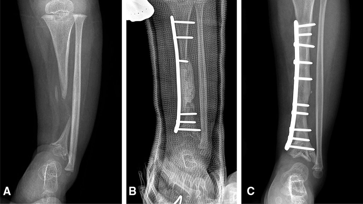 OfficialJAAOS's tweet photo. Tibial bone defects can really leave surgeons in a hole; @JanetConwayy gives some suggestions in this month's #JAAOS #OrthoTwitter https://t.co/7zf1ciw2Es https://t.co/s0ec2pyRyX