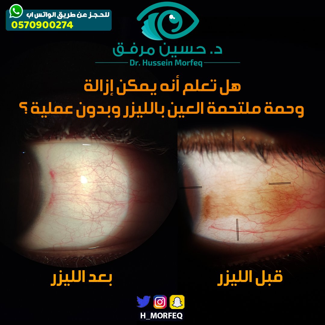 إزالة وحمة العين الخارجية يتم باستخدام ليزر خارجي وبدون جراحة وفي ثواني.

#وحمة 
#ملتحمة_العين 
#ليزر 
#طبيب 
#جدة_غير 
#صحتي
#جدة
#عيون