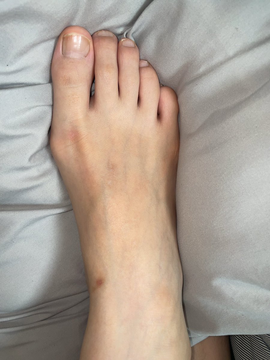 yomisfeet's tweet photo. 足の血管✨✨

足指が長い💗

172センチ26.5センチ大足女子の足！

こんなデカ足で踏まれたい🦶

#足　#足フェチ　#足裏　#フェチ　#足指　#女子　#長身　#長身女子　#足でか　#デカ足　#feet #feetsole #sole #bigfeet #feetsize https://t.co/4FRQjpagYR