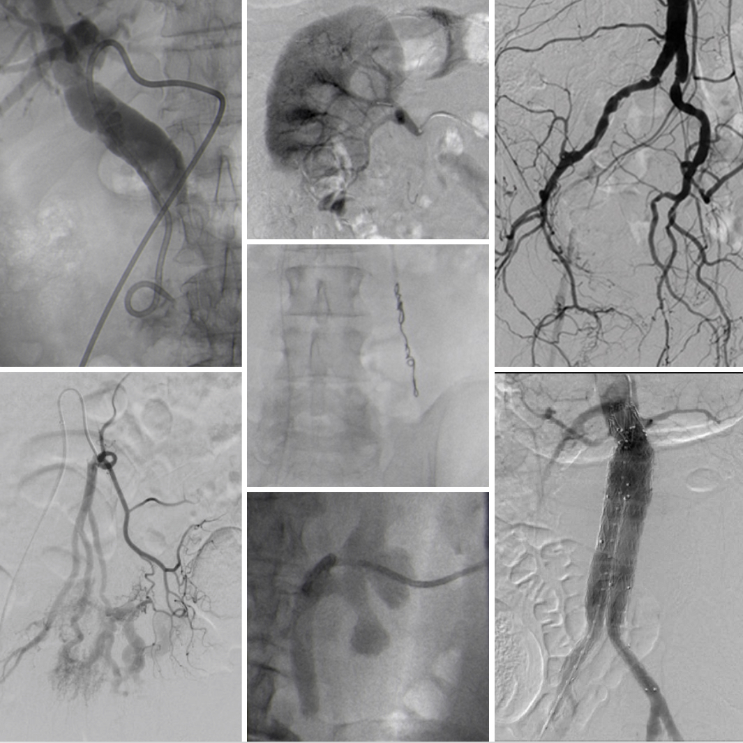Imaging MFT (@mft_imaging) on Twitter photo IR is a sub speciality of Radiology, we perform patient centred, image-guided, minimally invasive procedures. The range of conditions which can be treated by IR is enormous and continually expanding! <a href="/SCoRMembers/">SCoR Members</a> #wrd2021 IR is a sub speciality of Radiology, we perform patient centred, image-guided, minimally invasive procedures. The range of conditions which can be treated by IR is enormous and continually expanding! <a href="/SCoRMembers/">SCoR Members</a> #wrd2021
