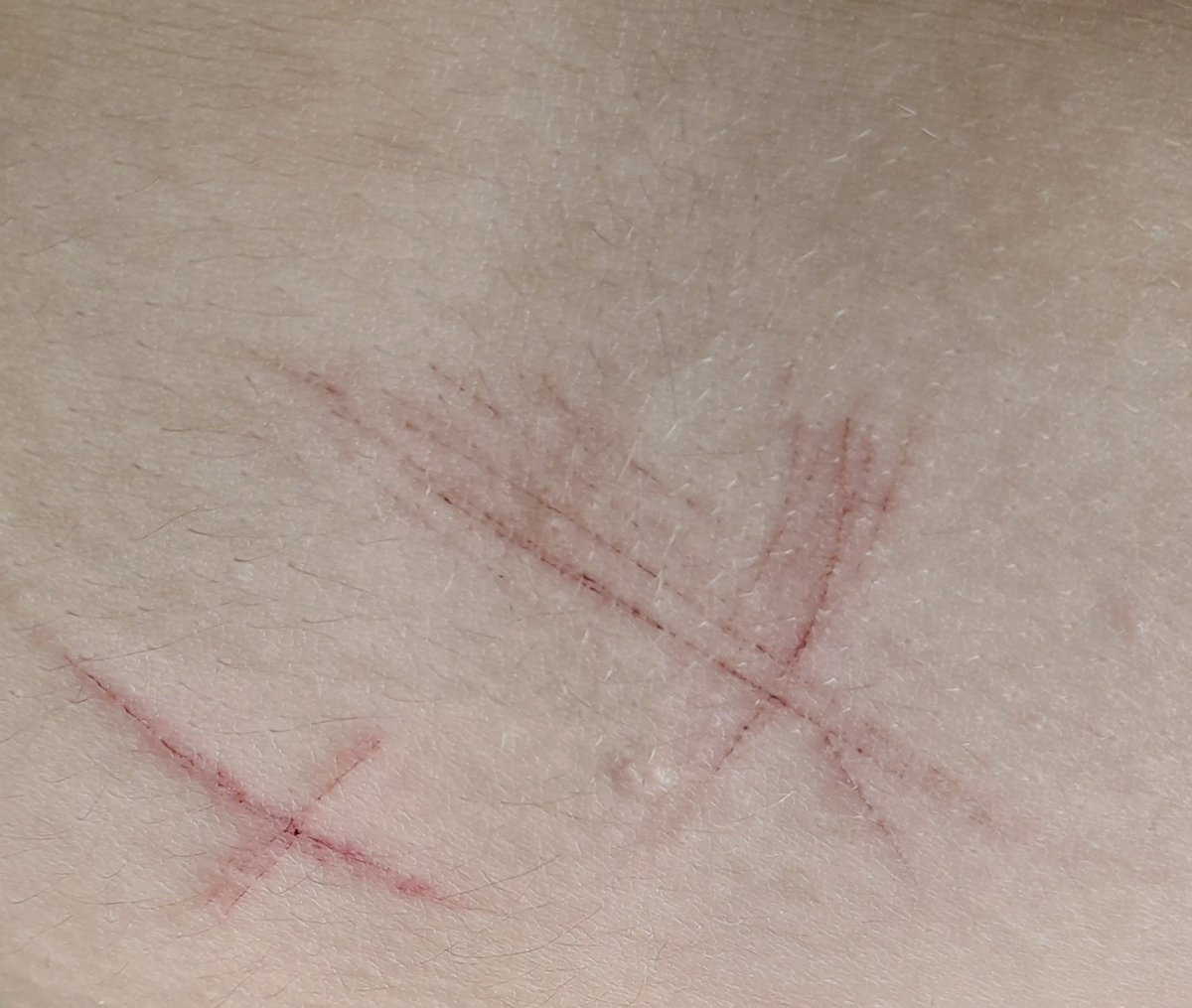 iwannaendmesoon's tweet photo. O-O /shtwt/
new addiction unlocked : carving Xs on my fat tummy 🙄
-Tags bcz idk :#shtwt #beantwt #styrotwt #ouchietwt #styro #catscratchtwt #shtwt #sliceytwt  #yeettwt #sltztwt #styrocuts #redhoneytwt #アムカ #リストカット #自傷行為 #shcuts #scabtwt #sliceytwt #ouchytwt https://t.co/30WG9qZB15