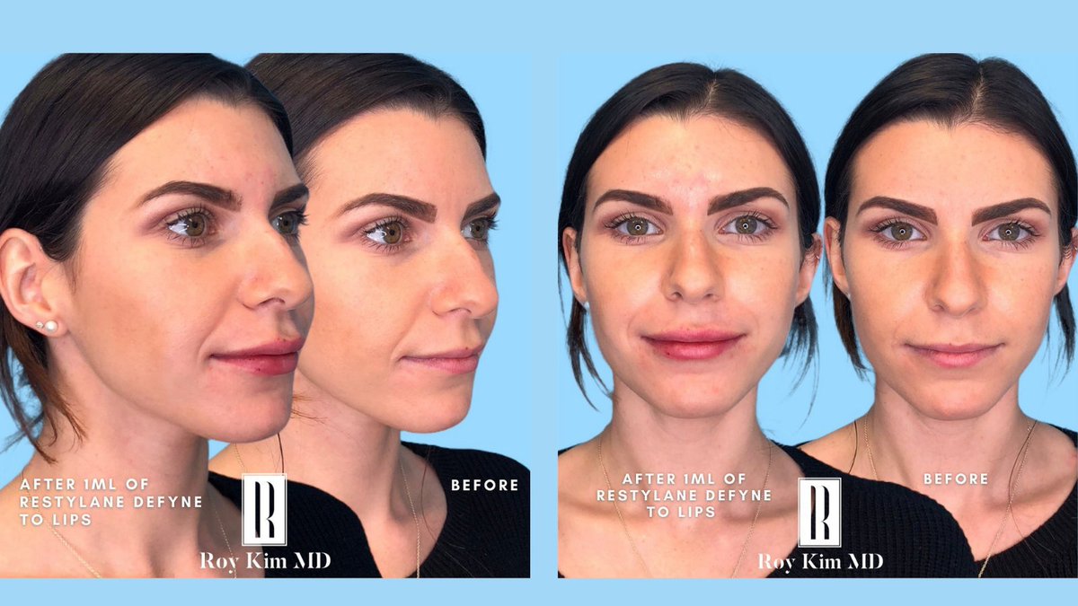 drroykim's tweet photo. Our beautiful patient received 1mL of Restylane Defyne to her lips to achieve more volume, while still looking like she’s never had anything done!
#lipfiller #lipinjections #restylanedefyne #restylanekysse #restylanelips #dermalfillers #philtralcolumns #philtrum #cupidsbow https://t.co/ZyxxBF1IYn