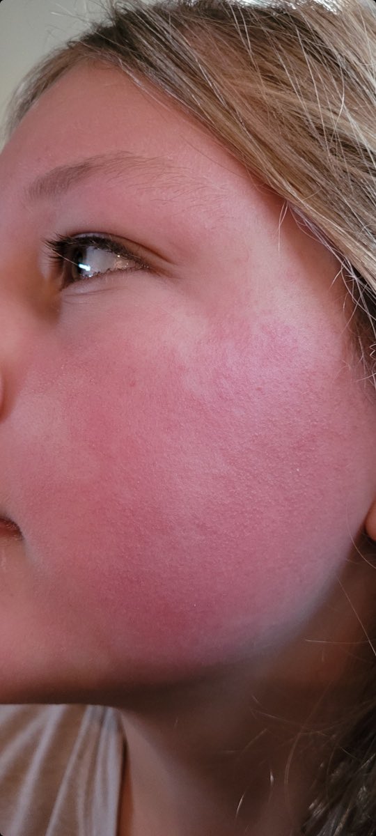 LadyRaven15's tweet photo. When #Snazaroo makeup say they’re safe for sensitive skin and tested, and they advertise for 3+ yo, but you end up at the clinic for severe rash… Safe, my ass!! #halloween2021 #makeup 😡😡😡 https://t.co/2xQYiioaXU