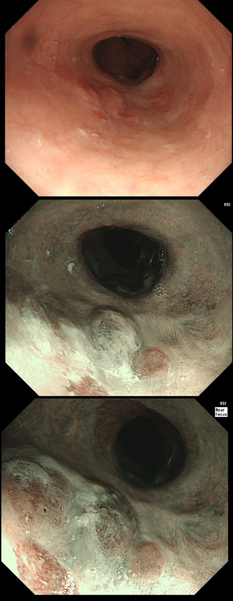 Subtle irregularity found in the distal oesophagus
WHAT IS THE MOST LIKELY DIAGNOSIS?
a) Reflux oesophagitis
b) Squamous dysplasia
c) Dysplastic Barrett's
d) Squamous carcinoma
e) Barrett's carcinoma

Answer: E! 
For a full explanation check out friendsofendoscopy.org