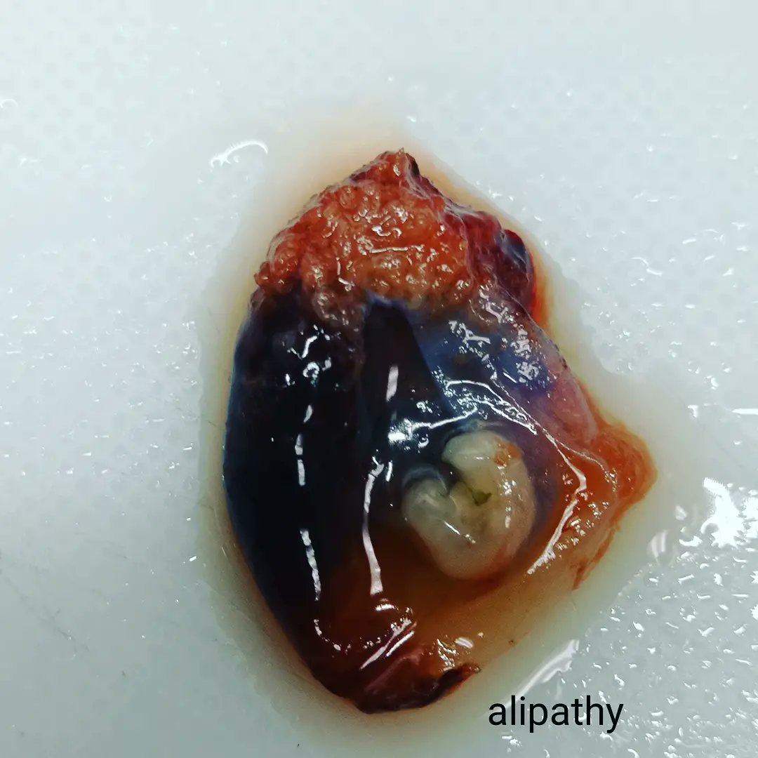 Alipathy's tweet photo. Saco gestacional íntegro. En la segunda imagen se observa embrión de 1cm de longitud lo que corresponde a aproximadamente la 6-7ma de edad gestacional,en esta etapa empieza la organogénesisy el tubo neural empieza a cerrarse.#pathology #patologia #macroscopia #grossgnosis https://t.co/zE242OdFKF