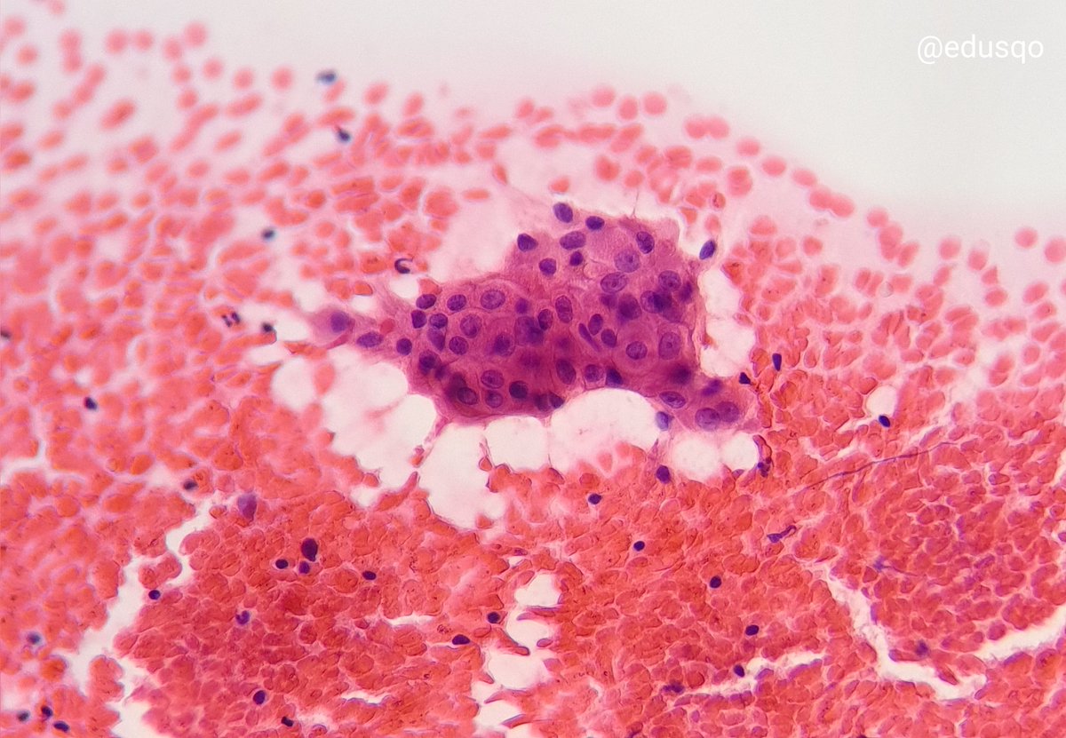 edusqo's tweet photo. Buenas vibraciones comenzar la semana diagnosticando patologías benignas...y, sobre todo, disminuir la ansiedad del paciente al descartar la sospecha de linfoma.
#Diagnóstico #AnatomíaPatológica #CytoPath #Warthin en hematoxilina-eosina, giemsa, papanicolaou y bloque celular. https://t.co/u1EmBKysbB