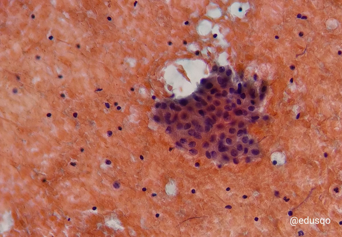 edusqo's tweet photo. Buenas vibraciones comenzar la semana diagnosticando patologías benignas...y, sobre todo, disminuir la ansiedad del paciente al descartar la sospecha de linfoma.
#Diagnóstico #AnatomíaPatológica #CytoPath #Warthin en hematoxilina-eosina, giemsa, papanicolaou y bloque celular. https://t.co/u1EmBKysbB