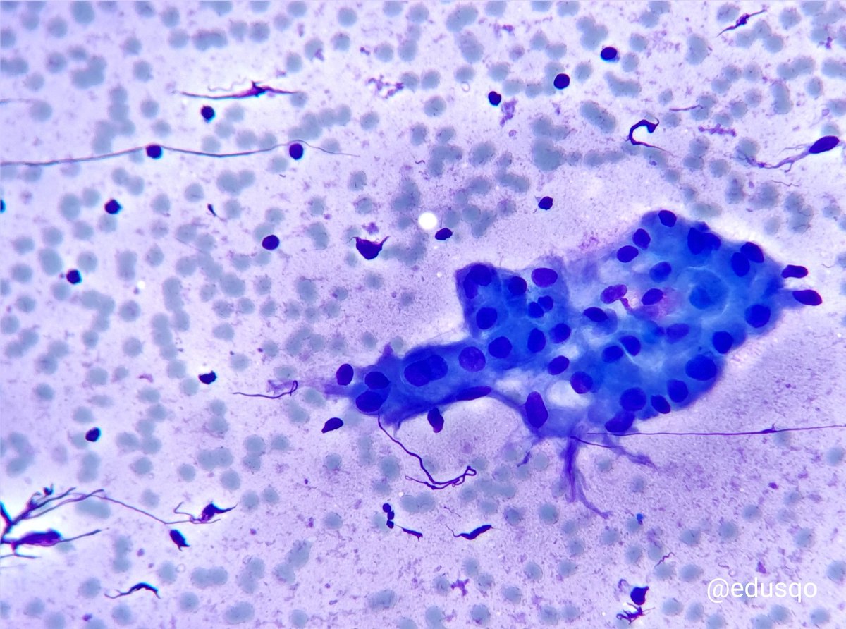 edusqo's tweet photo. Buenas vibraciones comenzar la semana diagnosticando patologías benignas...y, sobre todo, disminuir la ansiedad del paciente al descartar la sospecha de linfoma.
#Diagnóstico #AnatomíaPatológica #CytoPath #Warthin en hematoxilina-eosina, giemsa, papanicolaou y bloque celular. https://t.co/u1EmBKysbB