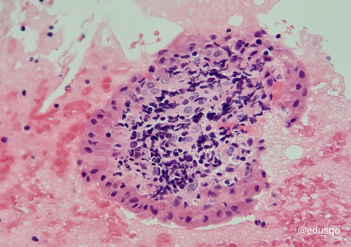 edusqo's tweet photo. Buenas vibraciones comenzar la semana diagnosticando patologías benignas...y, sobre todo, disminuir la ansiedad del paciente al descartar la sospecha de linfoma.
#Diagnóstico #AnatomíaPatológica #CytoPath #Warthin en hematoxilina-eosina, giemsa, papanicolaou y bloque celular. https://t.co/u1EmBKysbB