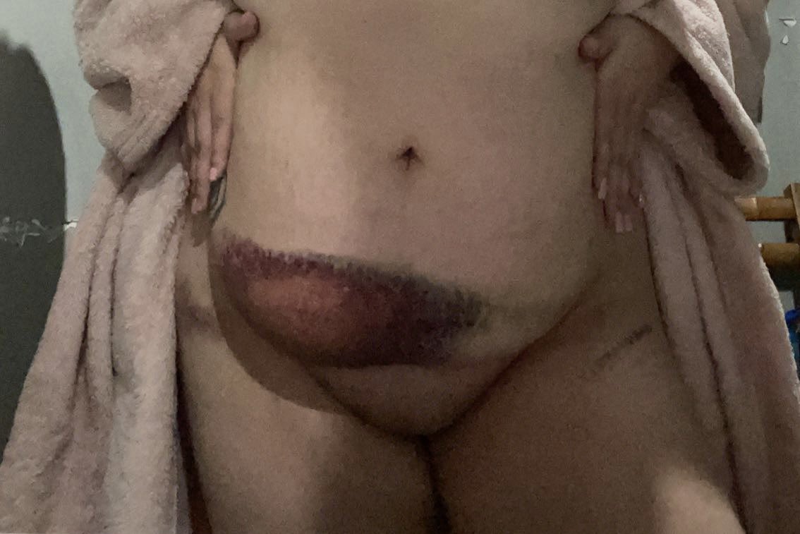 QueenAvitas's tweet photo. TW// car crash, bruises
my brakes failed and i hit someone at about 55 mph. i have cracked ribs and sternum. i’m out of work and would love to make some content for you. add my snap (queeenavitas)
#Accident #snap #freesnap #nsfw #ContentCreator #content #blonde #bruised #help https://t.co/oM9054e6sf