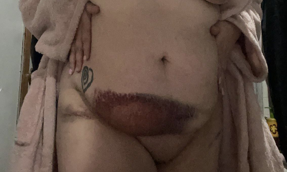 QueenAvitas's tweet photo. TW// car crash, bruises
my brakes failed and i hit someone at about 55 mph. i have cracked ribs and sternum. i’m out of work and would love to make some content for you. add my snap (queeenavitas)
#Accident #snap #freesnap #nsfw #ContentCreator #content #blonde #bruised #help https://t.co/oM9054e6sf