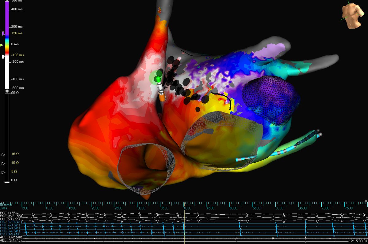 Mitral AFL utilizing Bachmanns Bundle fibers as an epicardial connection - let’s get into it! Upon ablating an anterior mitral line, we extend our CL by 65ms. Further LA ablation proves no change to TCL - We ultimately terminate AFL at the septal RA/SVC junction by contact alone!