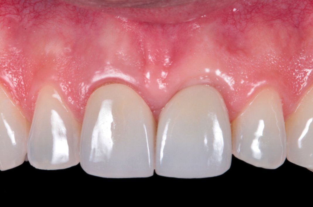 InDentalTech's tweet photo. Read “Optical Behaviors of Zirconia-Based Restorations Over Teeth and Implants in the Esthetic Zone” by Caroline F. Rafael, DDS, MSc, PhD, et al, take a short quiz, and earn 1 CE credit! https://t.co/VBoqIVcWBl #ContinueYourEducation https://t.co/6N8knpT5st