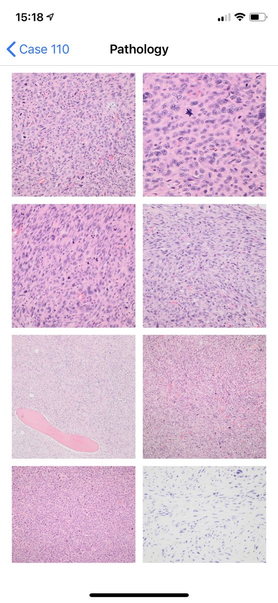 BoSTT_app's tweet photo. New case: Case 110 in the app. A bone tumour. #bstpath #pathology #radiology #MSKrad #sarcoma #FOAMed #FOAMrad https://t.co/Uc7Ucp7qNO