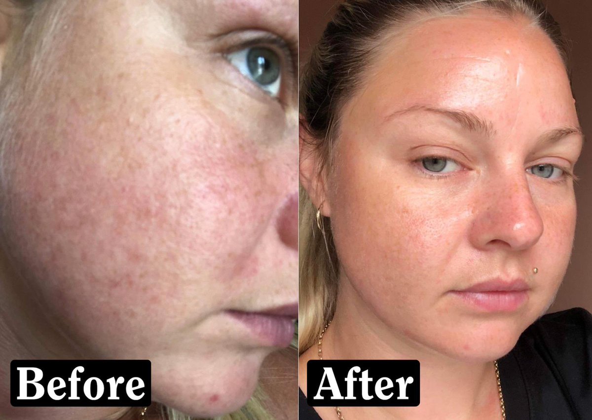 m_o_n_e1's tweet photo. Before I was introduced to a skin care my skin was dry, dull and pigmentation showed up. I wasn’t confident and I didn’t enjoy my skin, when I applied makeup it would look awful but I couldn’t leave the house without wearing makeup. However today I’m standing here confident xx https://t.co/vo1zXXFdvS