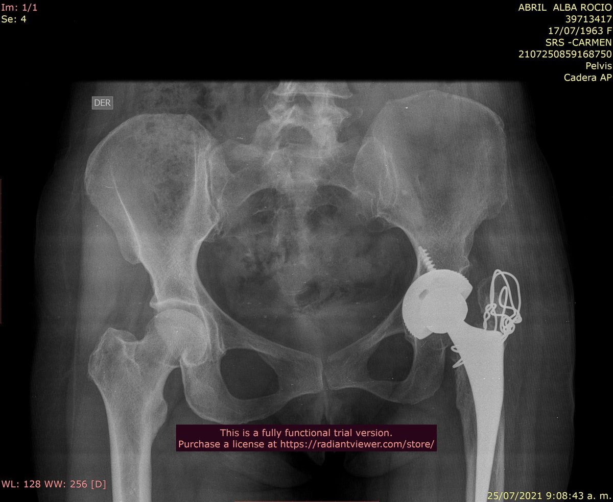 DrPasm's tweet photo. New case of the day for revision. 😣
Intervened in June 2019, today, she presents a shortening of the femur 4 cm, partial support of the left leg on crutches
#hipreplacement #hipreplacementsurgery #hipreplacements #hipreplacementproblems #hipreplacementsuccess #hipsurgeon https://t.co/7UliXk7MyH