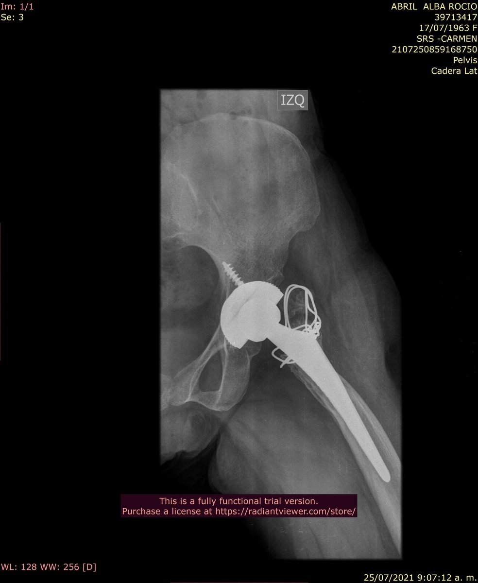 DrPasm's tweet photo. New case of the day for revision. 😣
Intervened in June 2019, today, she presents a shortening of the femur 4 cm, partial support of the left leg on crutches
#hipreplacement #hipreplacementsurgery #hipreplacements #hipreplacementproblems #hipreplacementsuccess #hipsurgeon https://t.co/7UliXk7MyH