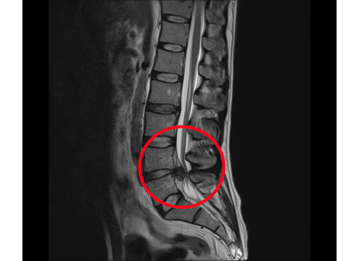 PalingClaire's tweet photo. Basics of Lumbar MRIs: Thread 3

This time we'll look at some common findings relating to the discs. https://t.co/OwRpamyw2I