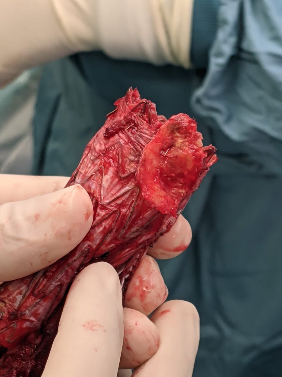 sbellmunt's tweet photo. “Don’t worry. It’s an EVAR with infrarenal fixation. It will be easy to remove...”                                                   The EVAR: https://t.co/tFxtv42B6w